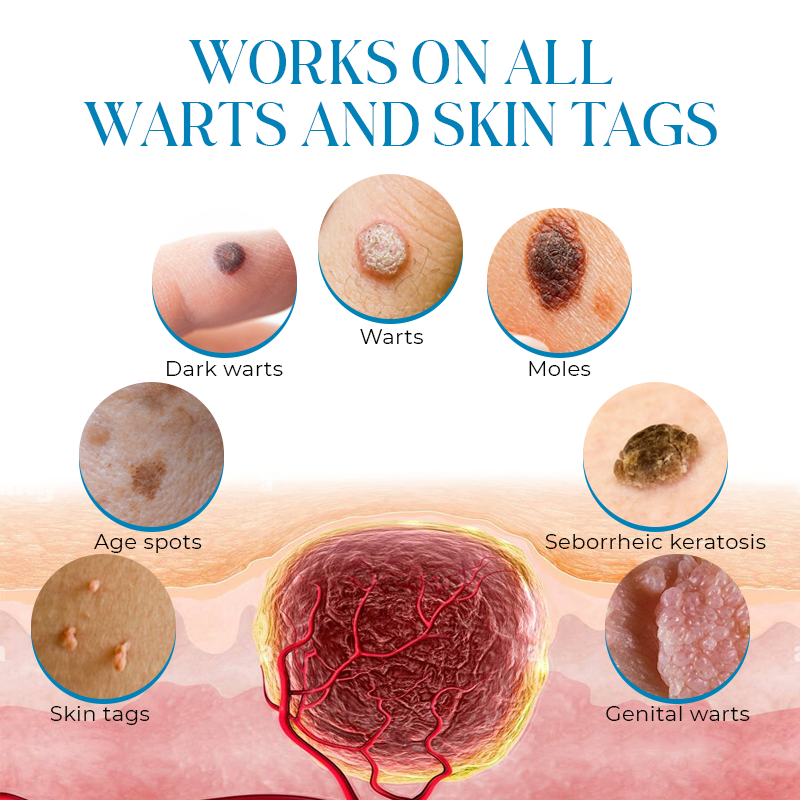 ⚡🔥Limited Time Only: Get 50% Off Now! 🎁 Seurico™ PapiClear Skin Tag & Wart Cream