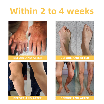 Seurico™ Arthritis and Varicose Vein Treatment Cream