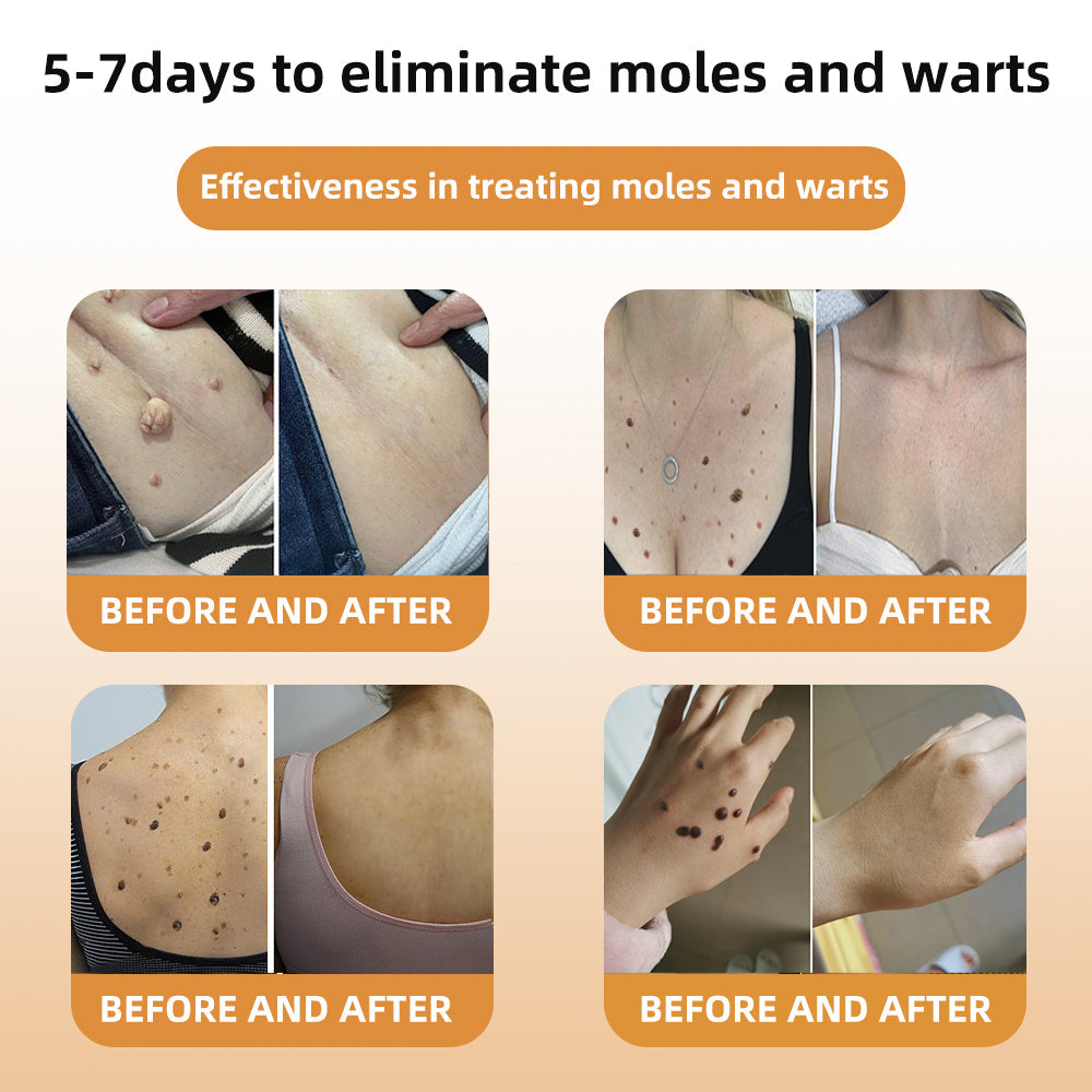 🎄 Holiday Sale Extravaganza: Enjoy 50% Off!  ✨Honeybee Venom Mole and Wart Cream
