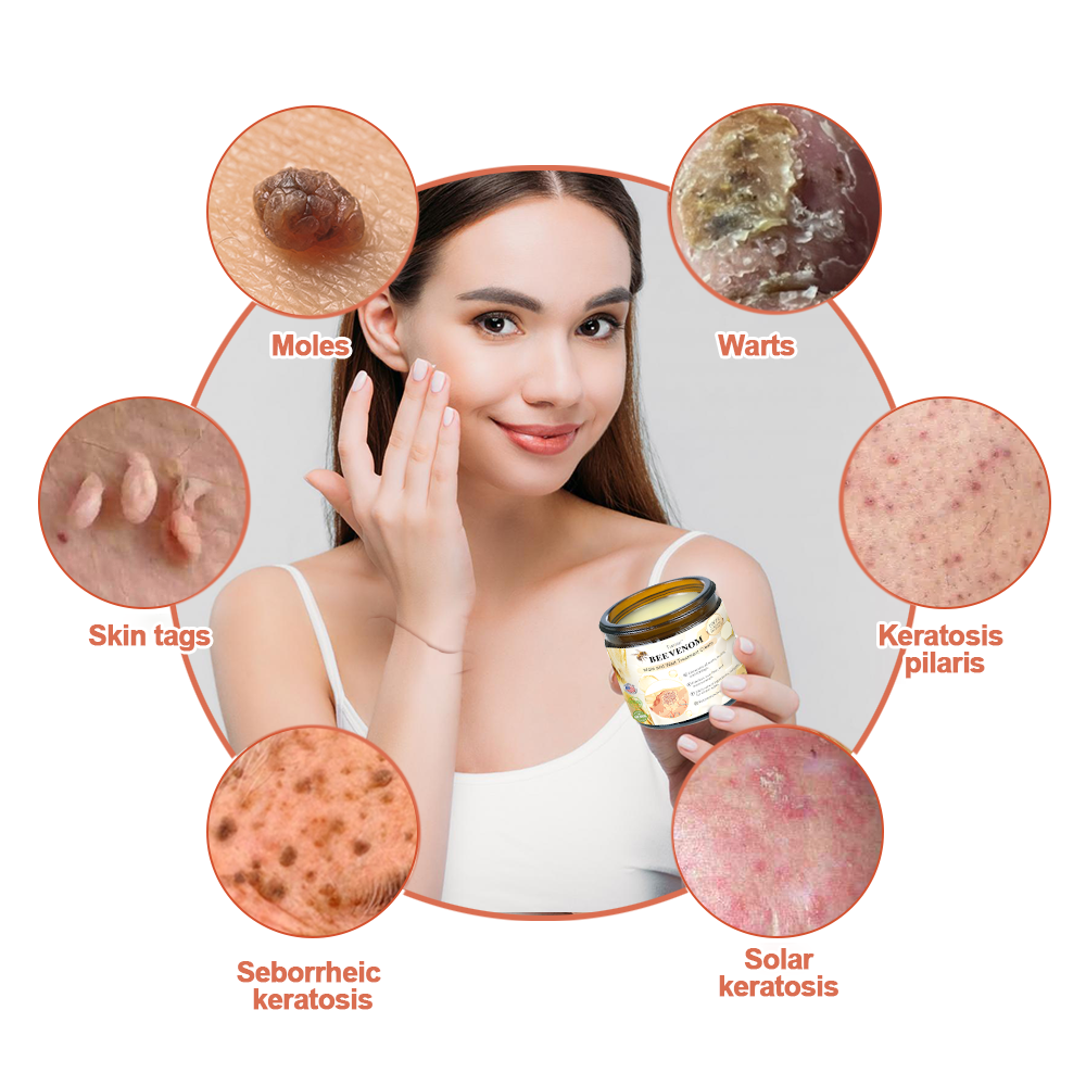 🎄 Holiday Sale Extravaganza: Enjoy 50% Off!  ✨Honeybee Venom Mole and Wart Cream