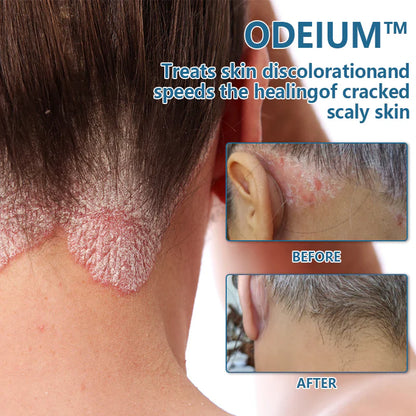 🔥ODEIUM™ Psoriasis Treatment Cream🔥 (for all skin conditions)