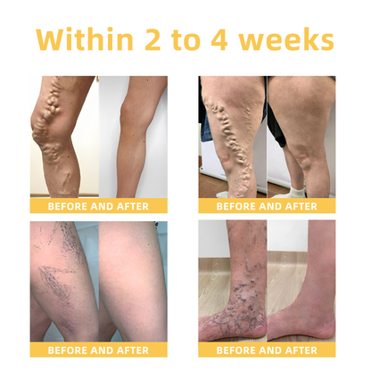 Seurico™ Arthritis and Varicose Vein Treatment Cream