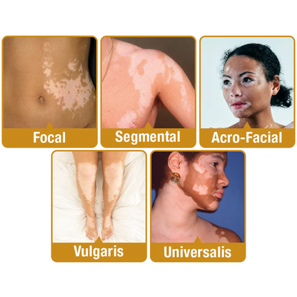 Seurico™ Bee Venom Vitiligo Treatment Cream