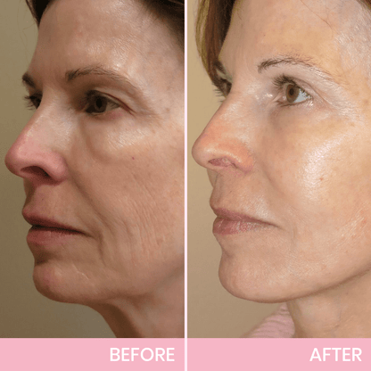 Seurico™ V-Face Lifting Adhesive Tape — Discreet, Waterproof Face Slimming Strips