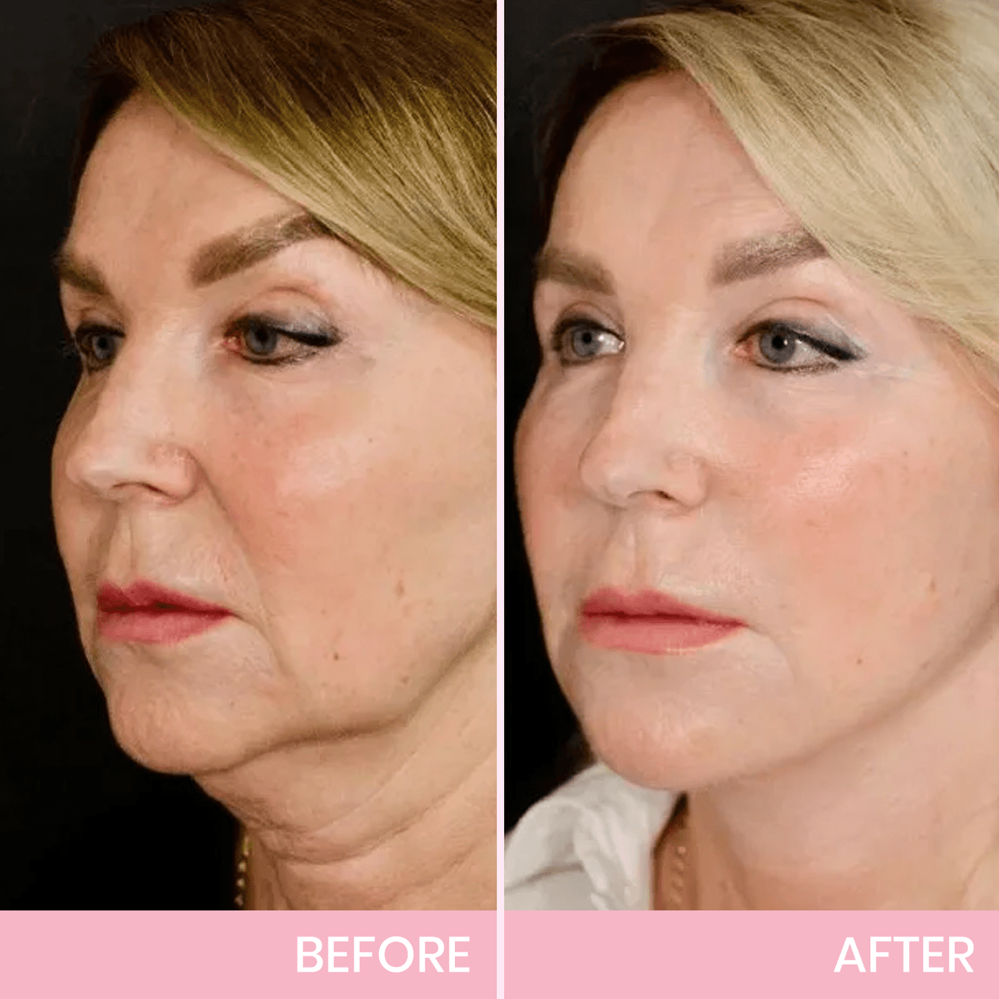Seurico™ V-Face Lifting Adhesive Tape — Discreet, Waterproof Face Slimming Strips