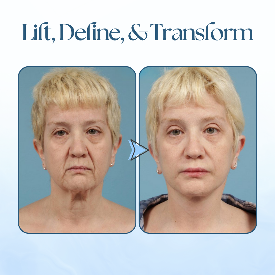 Clearance Blowout! 🚨 Seurico™ VDefine Face Lifting Tape