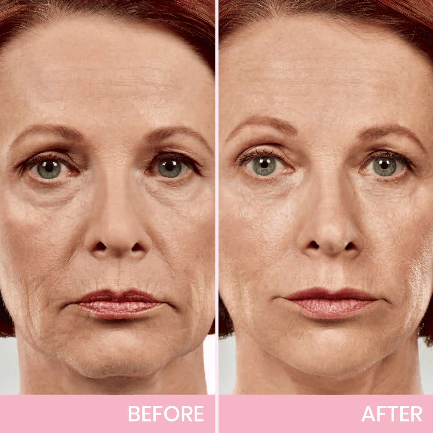 Seurico™ V-Face Lifting Adhesive Tape — Discreet, Waterproof Face Slimming Strips