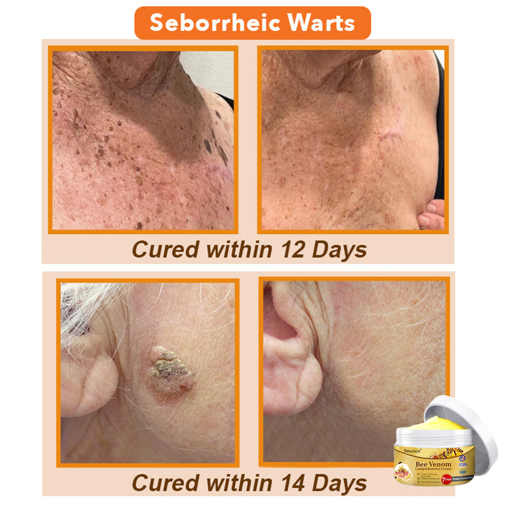 💕🐝Seurico™ Bee Venom Comprehensive Cream 🇺🇸 Dermatologist Recommended