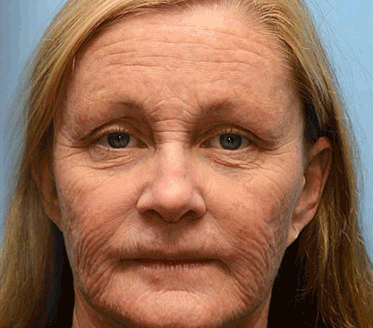 🎁Seurico™ Botox Bee Venom Wrinkle Removal Cream✨🐝