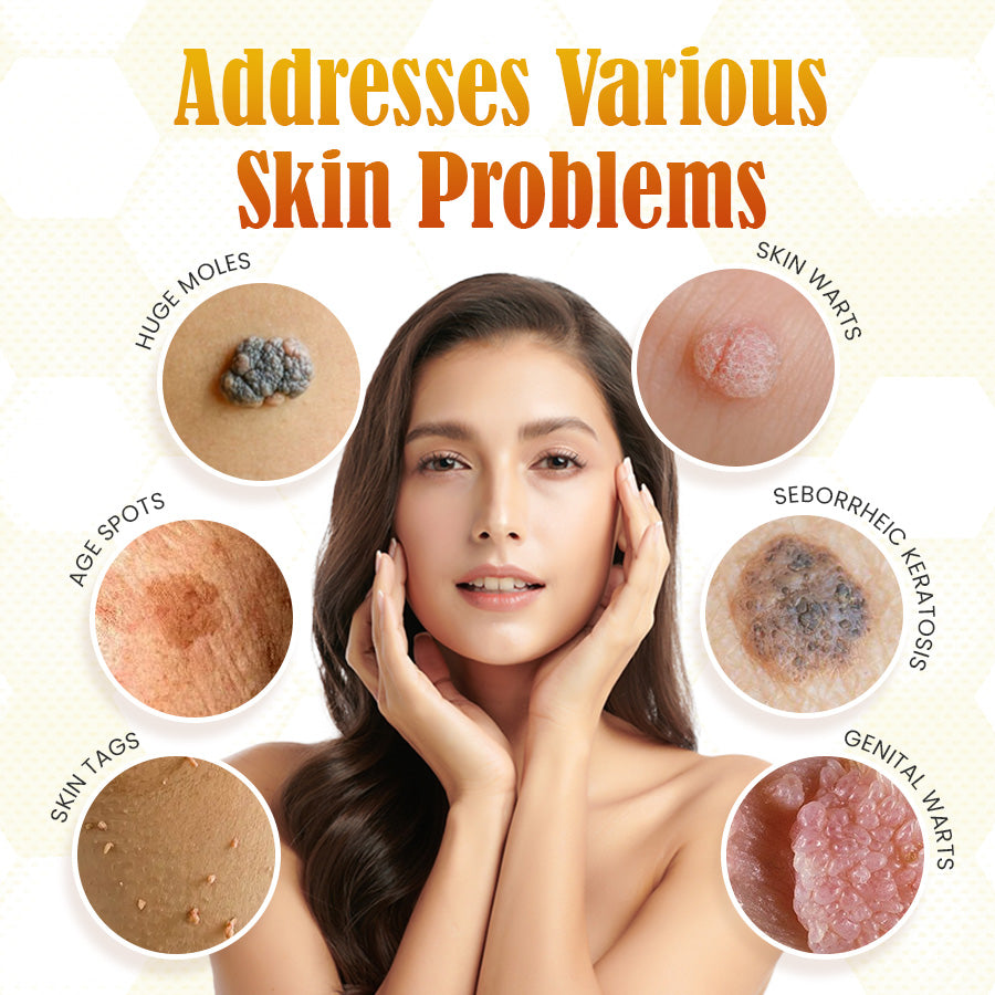 🎉[Official Store] 🎄 Holiday Sale Extravaganza: Enjoy 50% Off! 🎁Bee Venom Mole and Wart Cream