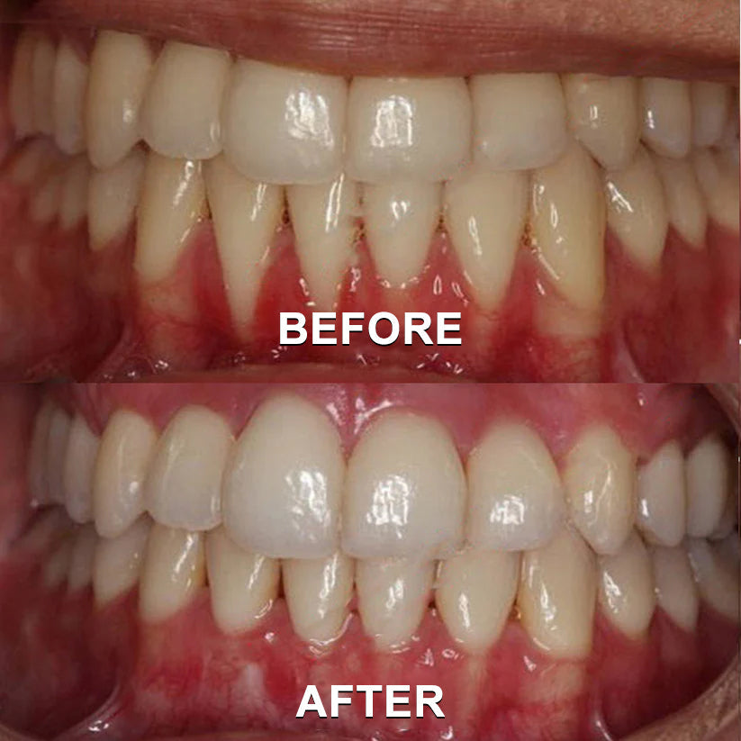 ✅ Seurico™ Gum Repair & Oral Health Powder (CE Certified for Periodontitis, Mouth Sores, and Gum Recession)